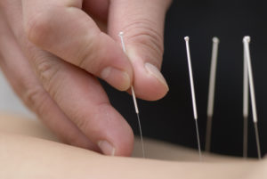 Treatment by acupuncture